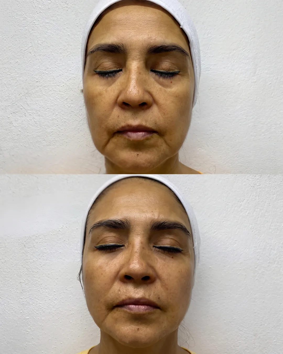 Lifting facial brasileño