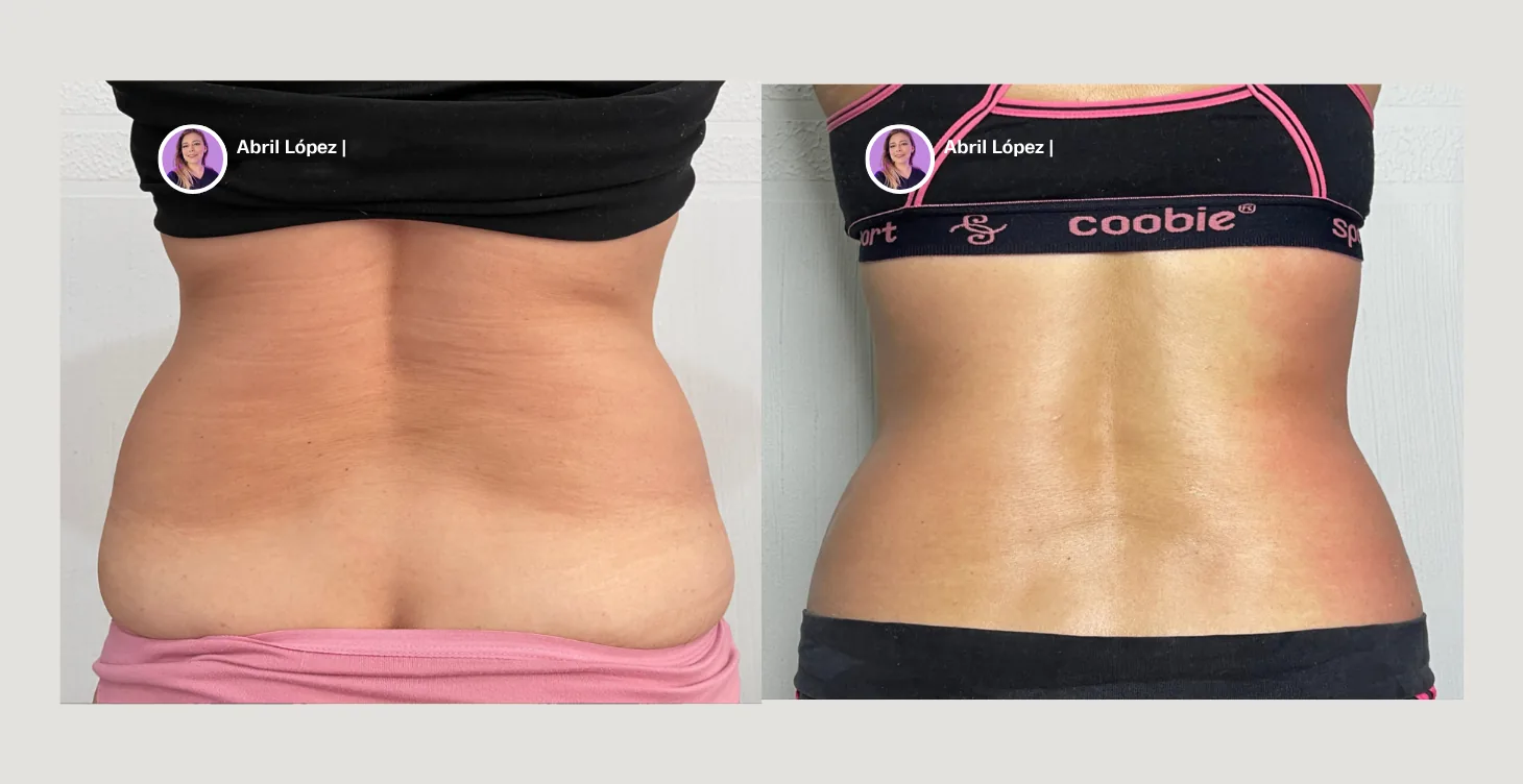 Resultado antes y después de tratamiento con diatermia
