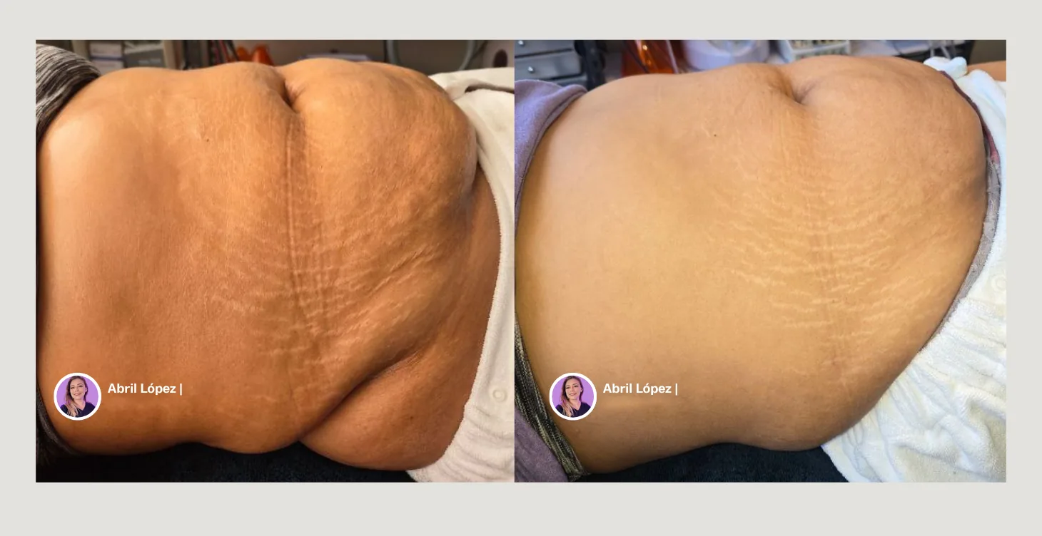 Resultado antes y después de tratamiento con diatermia