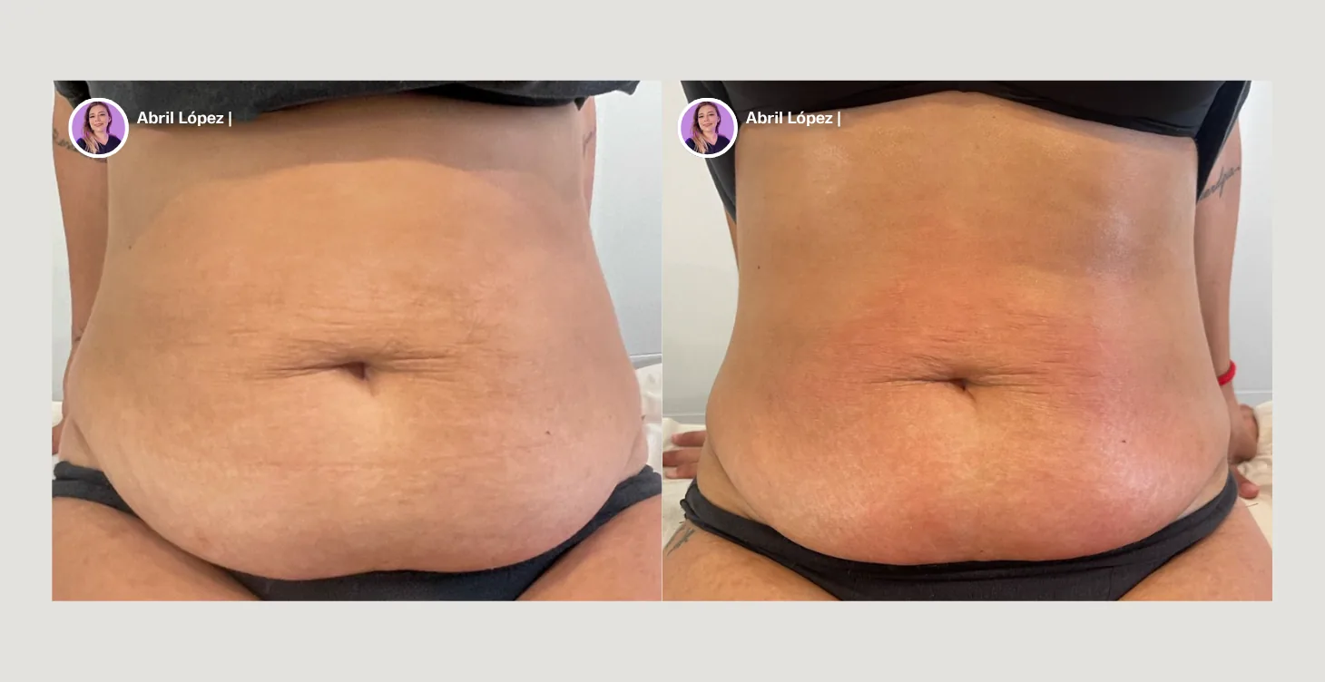 Resultado antes y después de tratamiento con diatermia