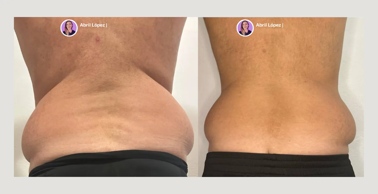 Resultado antes y después de tratamiento con diatermia